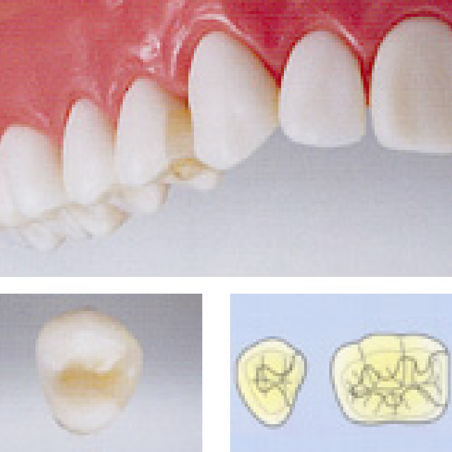 オールセラミックインレー