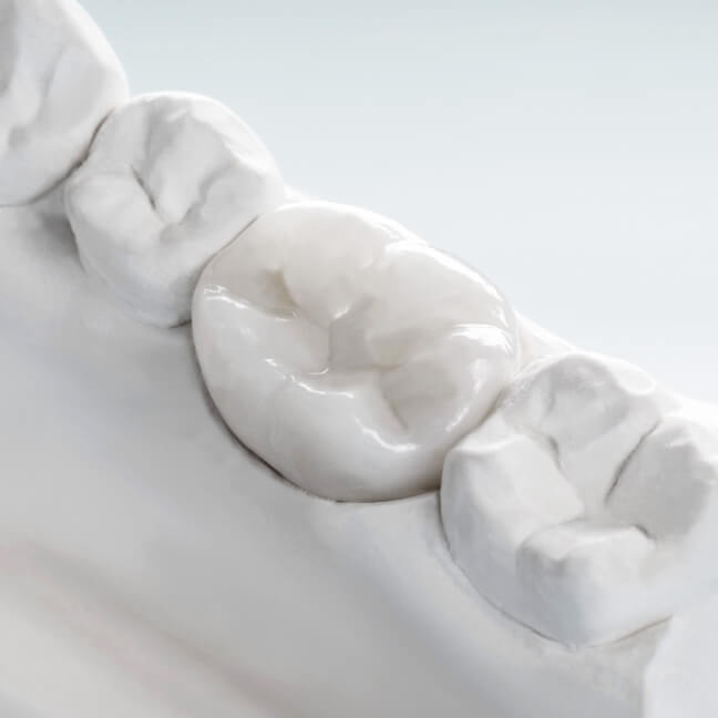 セラミック治療