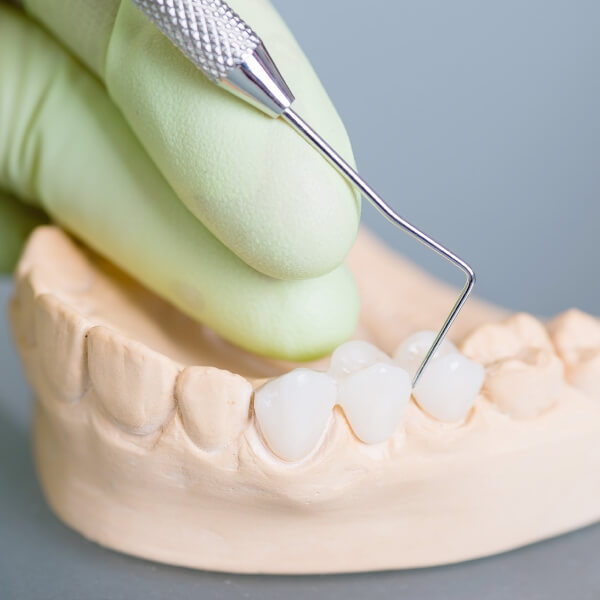 ブリッジとの違い