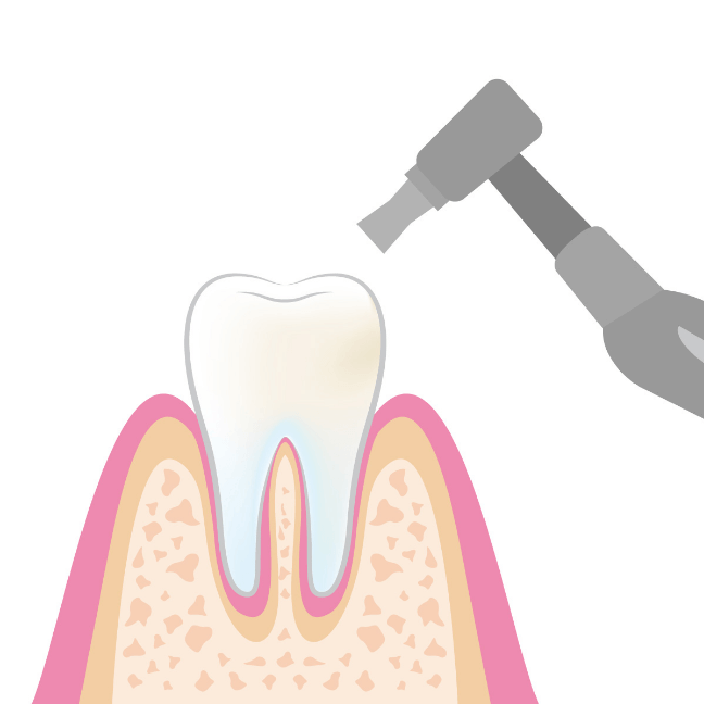 歯面の磨き上げ（ポリッシング）