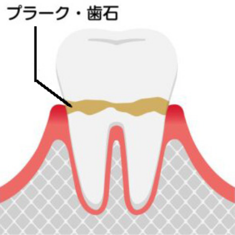 初期段階（歯肉炎）
