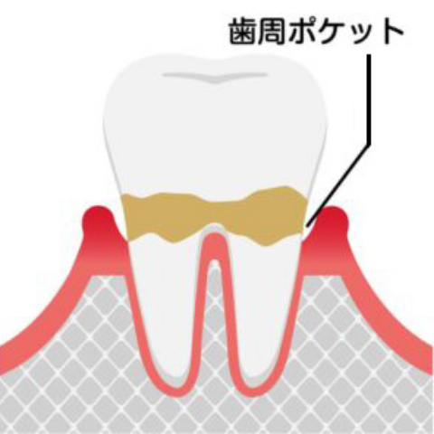 中期段階（軽度歯周炎）