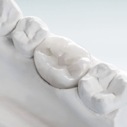 セラミック（審美治療）